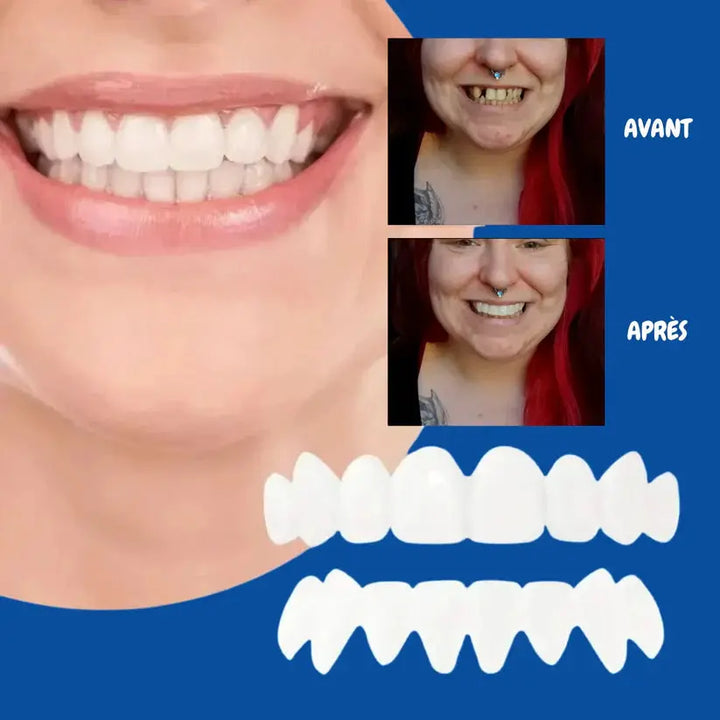 Facettes dentaires souples à clipser – Sourire immédiat NovaPlace